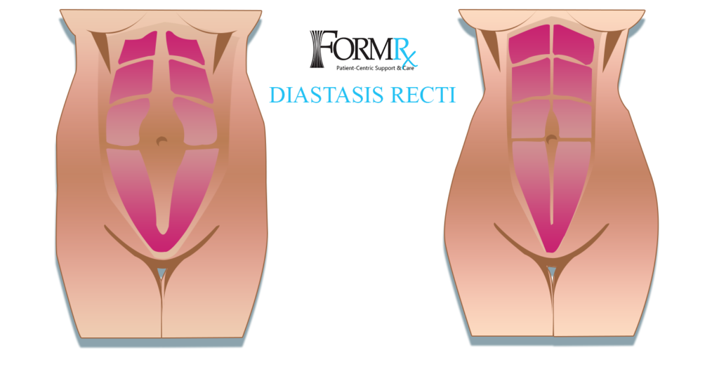 diastasis recti.